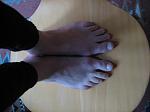 hallux_valgus_12_12_05_2.jpg