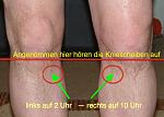 gout_knee.jpg