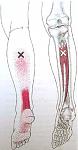 Tibialis_Pos[1].jpg