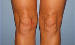 knee liposuction, smartlipo,vaser, before after, brian kerr md.p,k (2).jpg