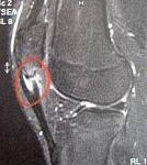 Patellaspitzensyndrom.jpg