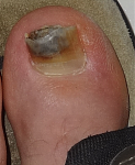 Zehe_Haematom_2014.png