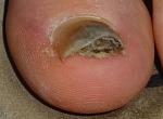 Zehe_Haematom_2014a.png