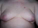 220px-Gynecomastia_001.jpg