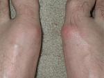 Hallux.jpg