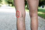 innenseite knie.jpg