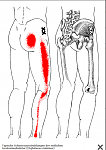 Triggerpunkte im Gluteus minimus.png