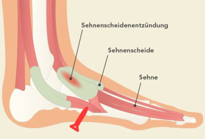 Sehnenscheidenentzuendung-fuss-liebscherbracht-20062022.png.jpg